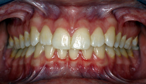 The permanent dentition contains only permanent teeth.